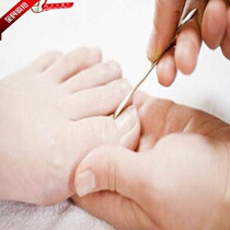 Professional pedicure foot footbed Grey nail nail Serie A chicken eye and other Beijing local vitiation services