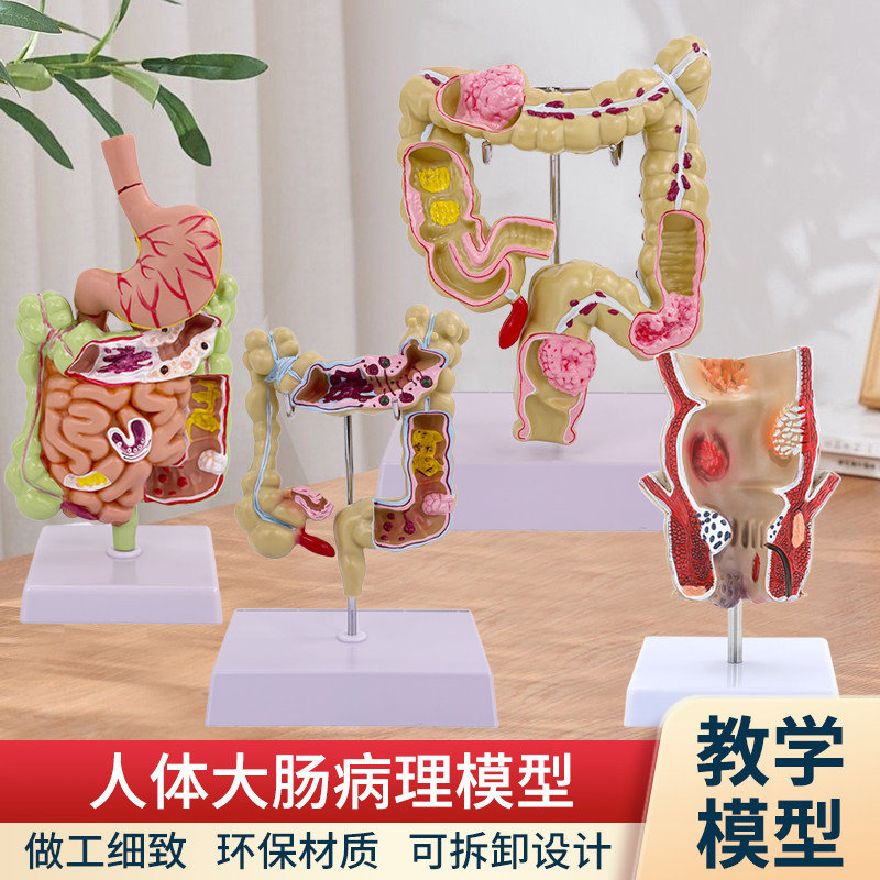 大肠病理模型大肠模型肠胃病变解剖模型肠道疾病人体结肠病变模型