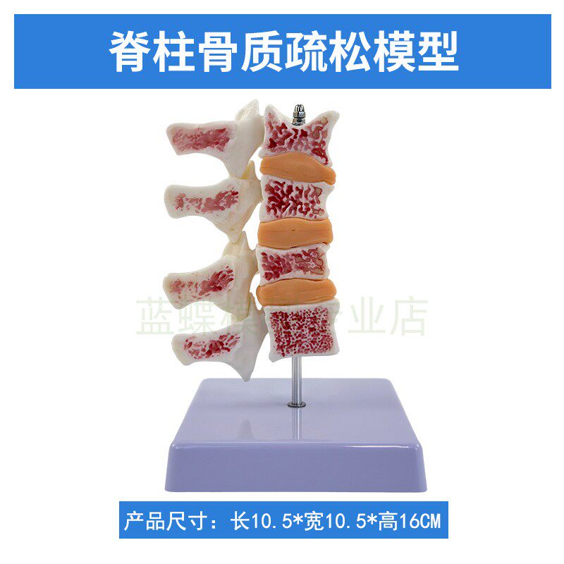 人体骨骼模型 骨质疏松病变 颈椎脊椎解剖模型 教学用 黄河品牌