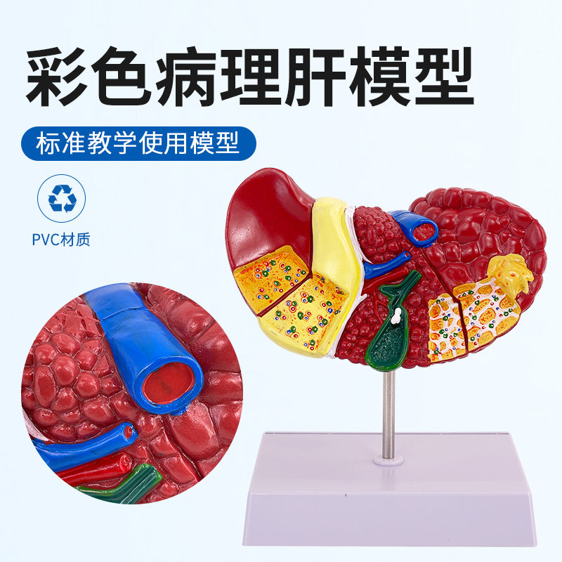 彩色病理肝模型 医患沟通用硬化脂肪炎教学展示 临床特征肝胆内科教具