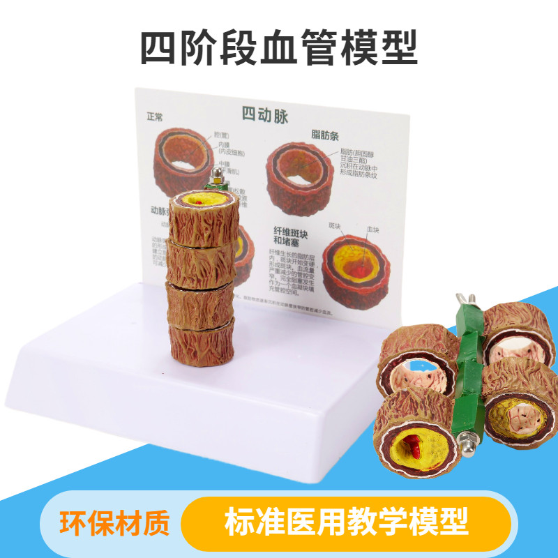 人体动脉粥样血管模型血栓病变模型四阶段心血管模型示教内科玩具