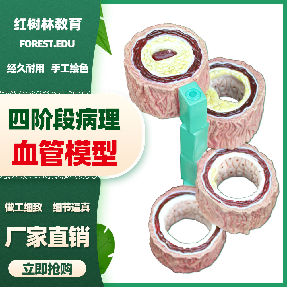 人体4阶段病理血管演示模型医院心内科动脉粥样硬化血管阻塞模型
