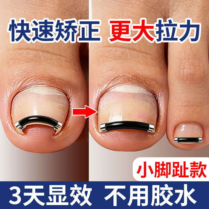 Ingrown Toenail Corrector, Little Toe Nail Correction Tool, Nail Correction Clip, Specialized Nail Correction Patch Ingrown Toenail Corrector, Little Toe Nail Correction Tool, Nail Correction Clip, Specialized Nail Correction Patch