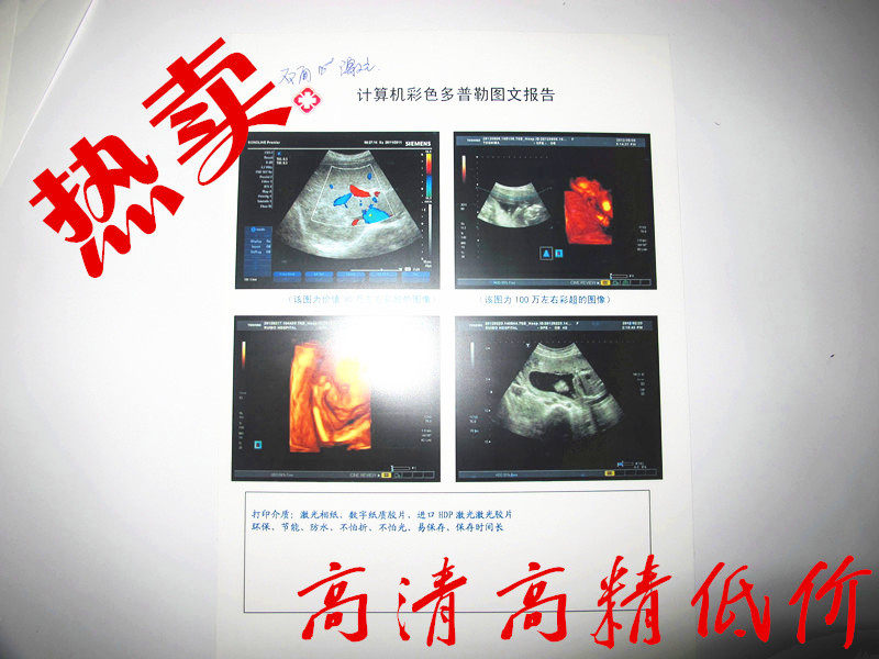 Inkjet medical printing negatives (white sheets) Porcelain white film CT Colour special medical negatives 100 packets