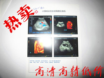 Inkjet medical printed film (white sheet) Porcelain White Film CT Color Special Medical Film 100 sheets