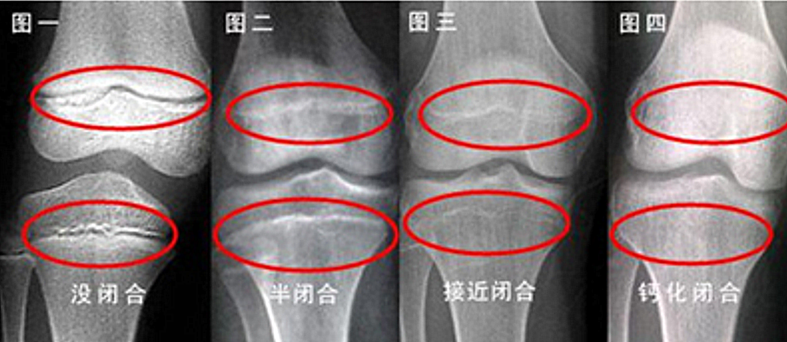 骨骺线闭合前后图片,膝盖骨骺线闭合图片,骨骺线闭合图_大山谷图库
