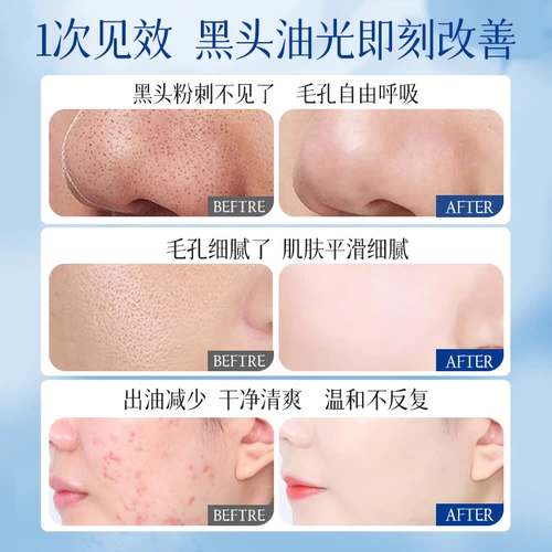 Средство для удаления прыщей от черных точек с салициловой кислотой, увлажняющая маска для лица, очищение пор, глубокое очищение, легкое нанесение