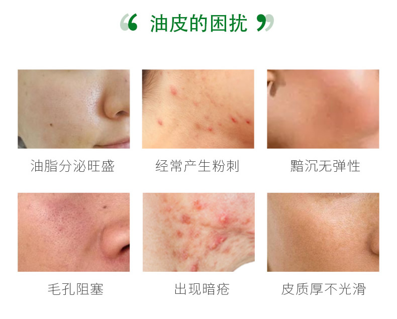 Niu er chính thức Tree Tree Acne Set Nước Sữa thu nhỏ Pore Điều khiển Dầu Da Mặt nạ đen Trang web chính hãng sữa dưỡng ẩm hada labo