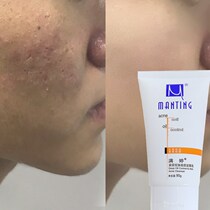 Control oil to remove acne print to blackhead for mites acne Acne Shrink Pores Moisturizing Water Recharge Suit Womens Wash Face Milk