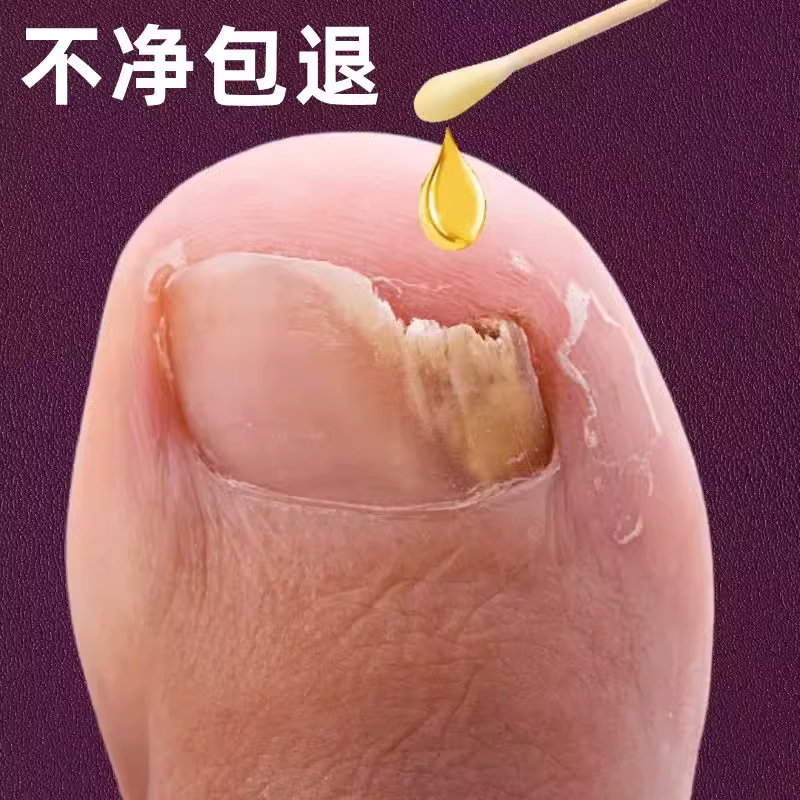 It's too good to not fix it sooner or later, it's too good a bad nail to change a good A finger toe repair to a good potassium-Taobao