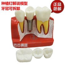 Oral dental model 4x implant explanation model Crown removable implant nail display model Doctor-patient communication