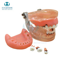 Oral teaching training tooth periodontal disease model to practice gingival scraping of dental calculus to remove doctor-patient communication