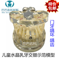 Oral childrens caries model deciduous teeth and permanent teeth alternate belt caries childrens pathological model caries caries C12