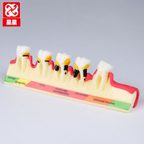 Oral periodontal classification model periodontal disease process model 4010 dental doctor-patient communication display model