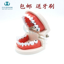 Dental tooth model Tooth Decay Model Pathology Model Kindergarten Teach Toothbrushing Model Children Tooth Decay Model