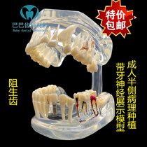 Dental oral model tooth decay caries with dental nerve demonstration wisdom tooth semi-lateral pathological model doctor-patient communication