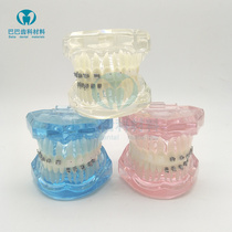 Dental orthodontic model Comparison model of 4 brackets Cermet lingual self-locking bracket demonstration model