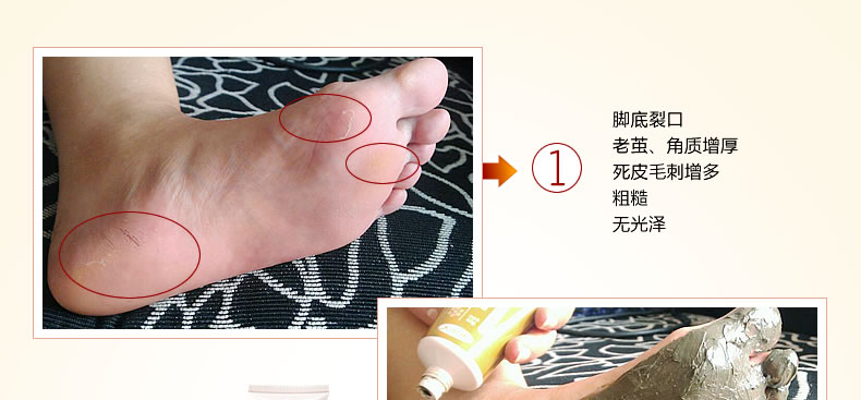 Tianmingzhu chân khô nứt chân kem chân phim để da chết ông già dịu dàng chân gót chân khô nứt chăm sóc bàn chân kem mặt nạ lột da chân