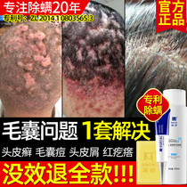 Manting scalp hair follicle pox mites removal mites deodorant mite deodorant mite head cleaning acne official flagship store