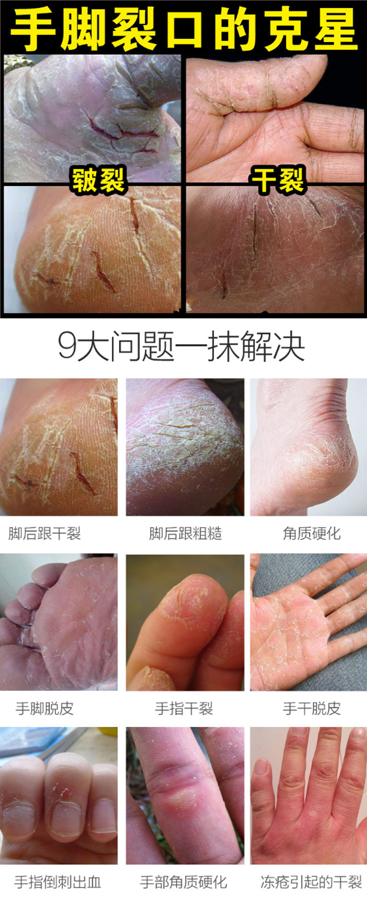 [Đặc biệt hàng ngày] Po Quan Ya chân phim để da chết cũ da lột chống khô chăm sóc bàn chân giữ ẩm chính hãng thuốc trị nứt chân