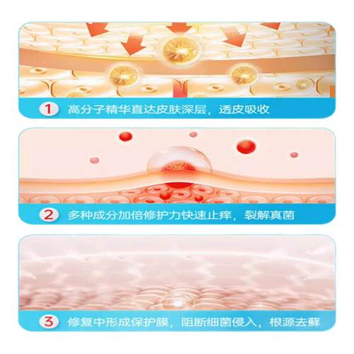 儿童治脚气止痒脱皮杀菌真菌感染专用喷雾正品专用烂汗脚丫水泡型