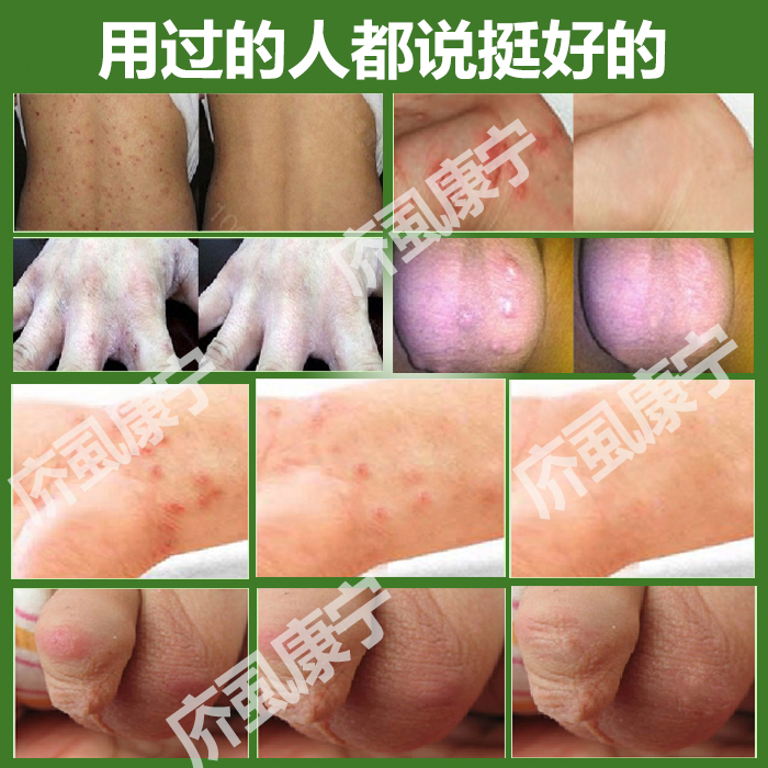 疥虱康宁特效止痒膏去庎螨霜硫磺软膏虫卵阴囊结节灵疥舒宁一扫光 小轩窗