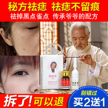 正品 去痣点痣药水点痣膏无痕除痣灵去黑痣祛斑点斑水去雀斑祛痣膏