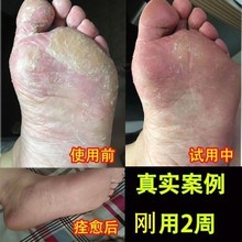 沁足雅鞋 袜除臭剂去脚气膏除脚臭止痒脚臭粉烂脚丫足光粉泡脚药包