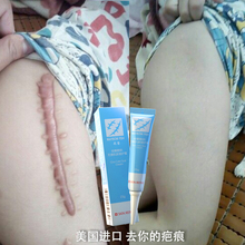 淡巴神器 快速去痕迹伤 凹凸修复你的巴巴