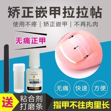 嵌甲甲勾炎矫正器拉拉帖特傚纠正手脚指甲往肉里长正甲贴片软甲膏