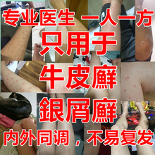 一人一方 牛皮膏银屑藓外用止痒病软膏偏方癬成人用药
