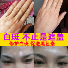 白柏哒诟且悍浪持久白癜風克星外用促黑色素修复肤色特效